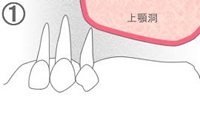 サイナスリフト